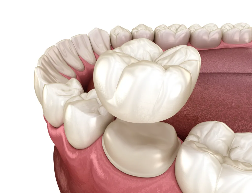 Preparated molar tooth for dental crown placement. Medically accurate 3D illustration